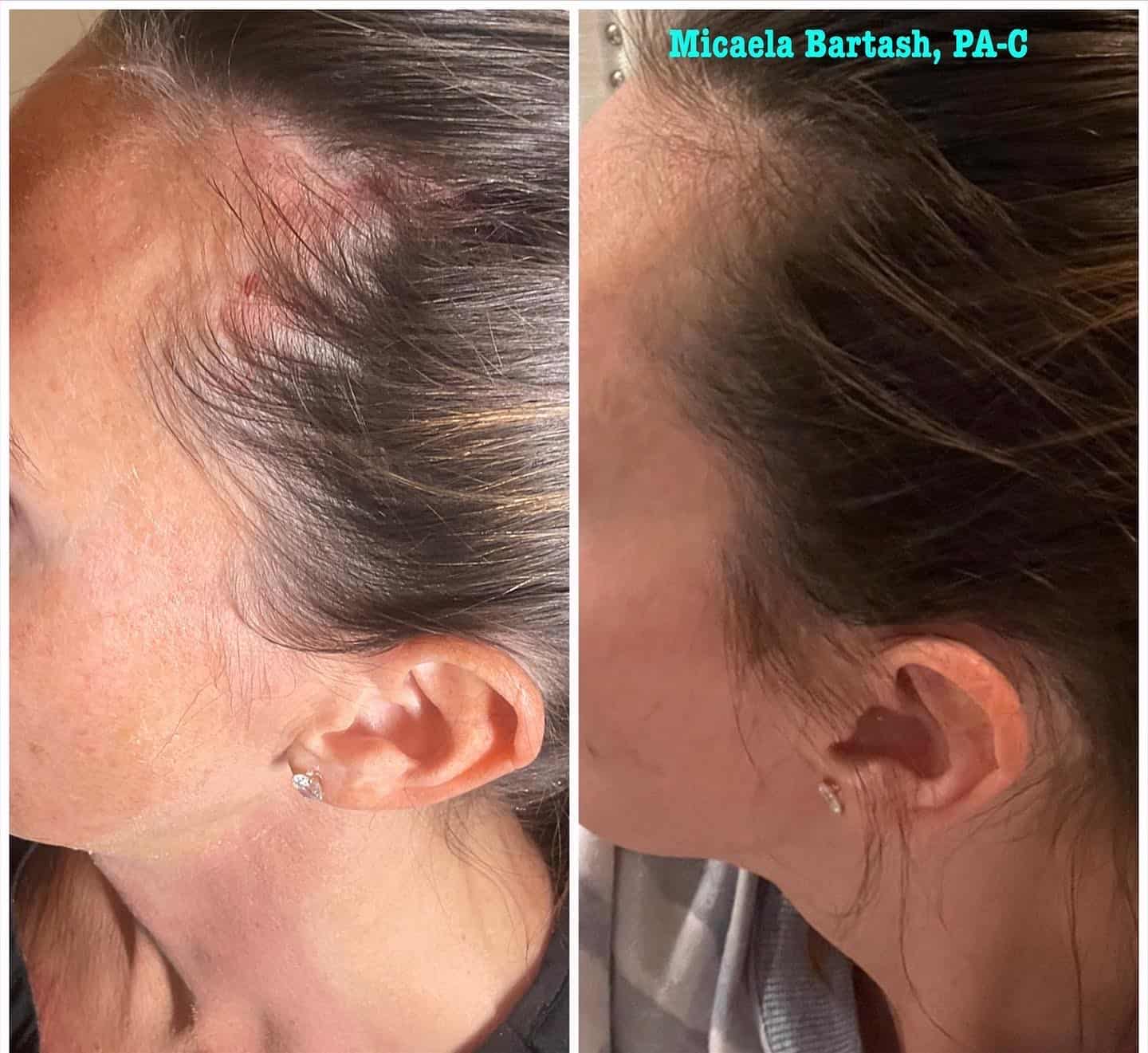 Hair restoration