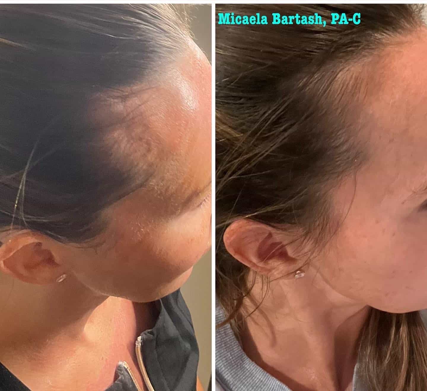 Hair restoration with PRF