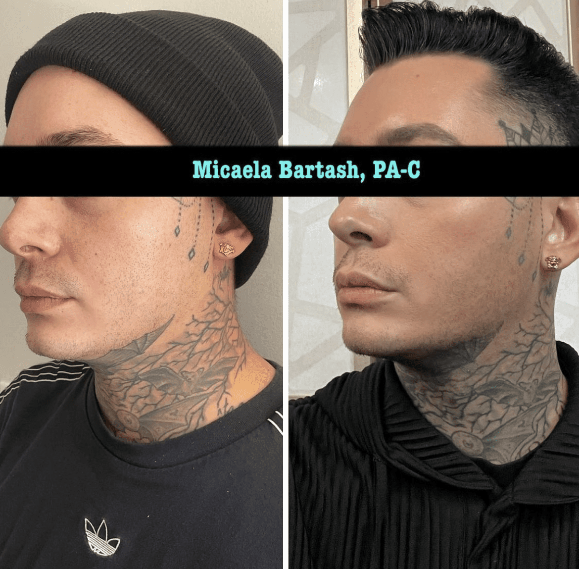Jawline Filler