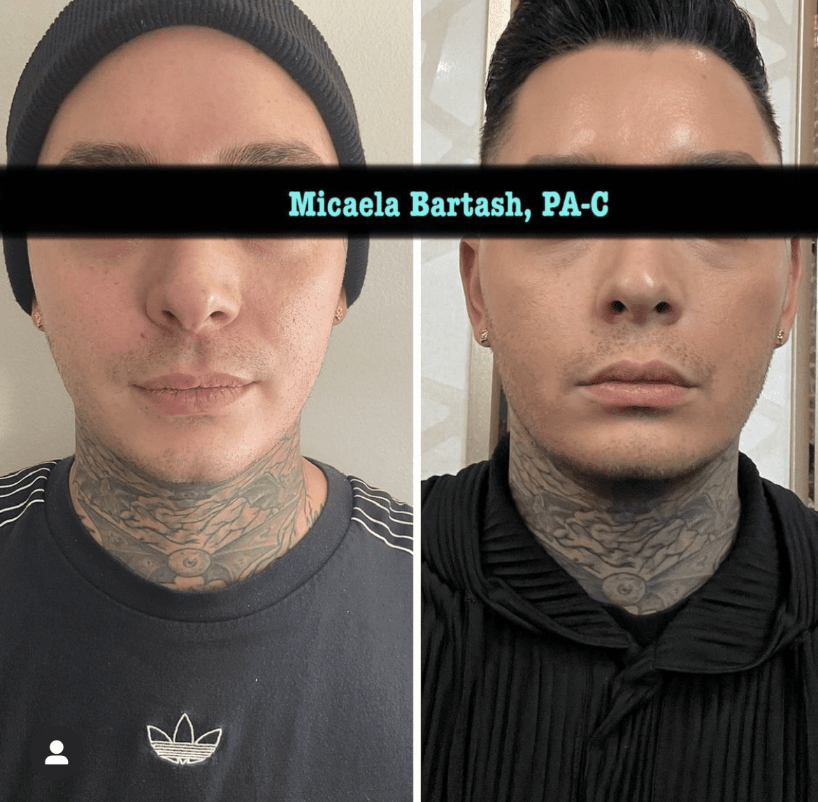 Jawline Filler