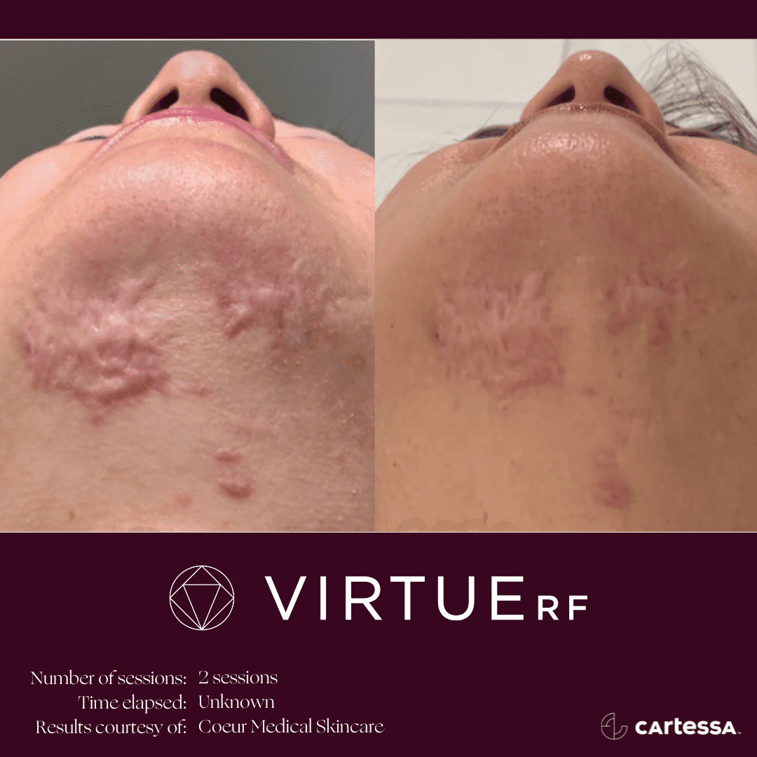 Virtue RF Scar