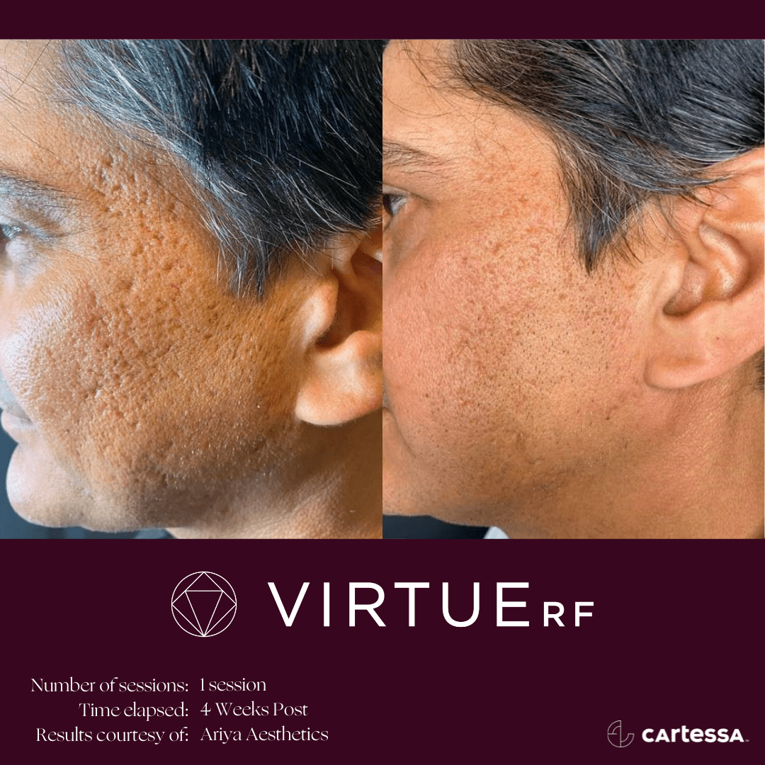 Skin texture