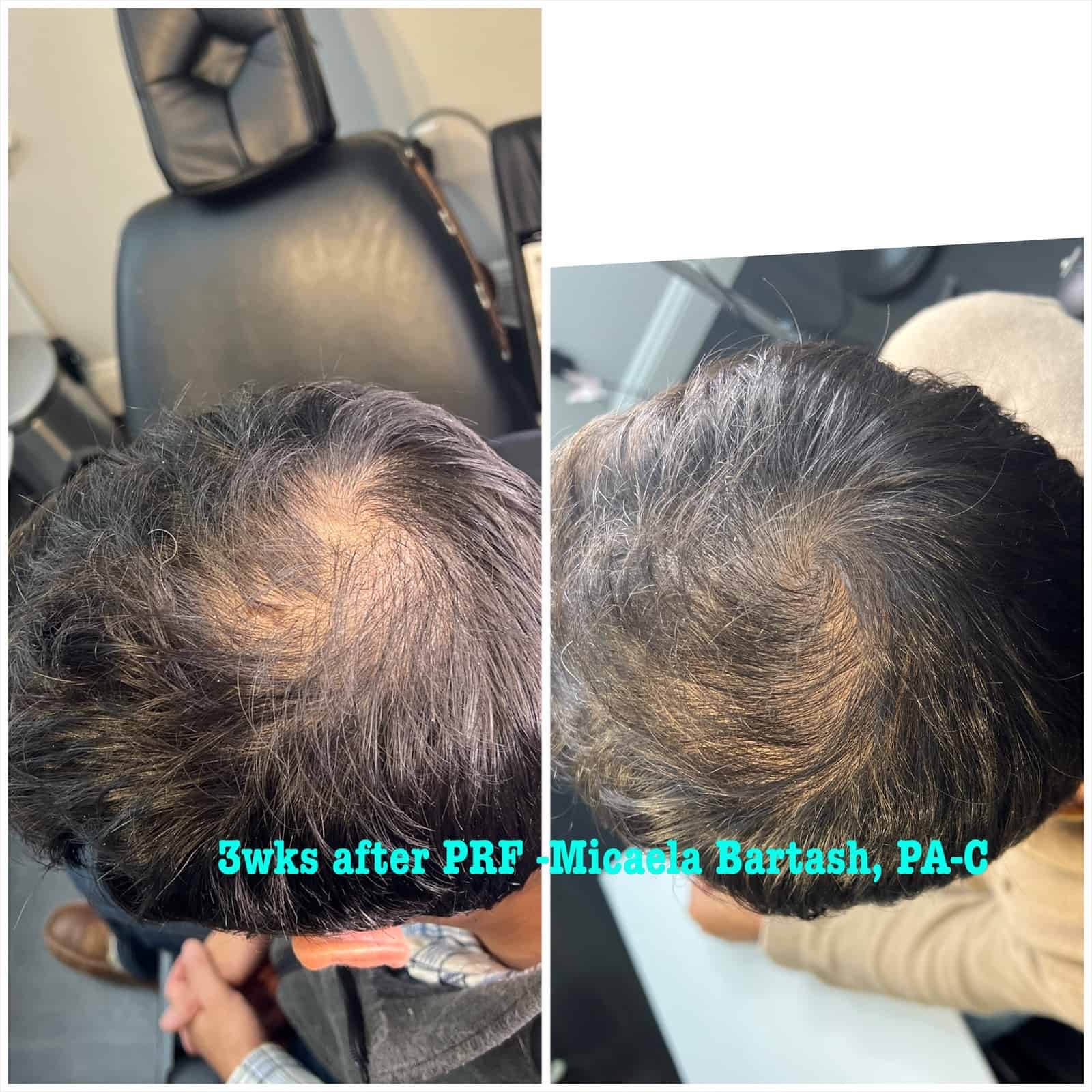 Hair Restoration