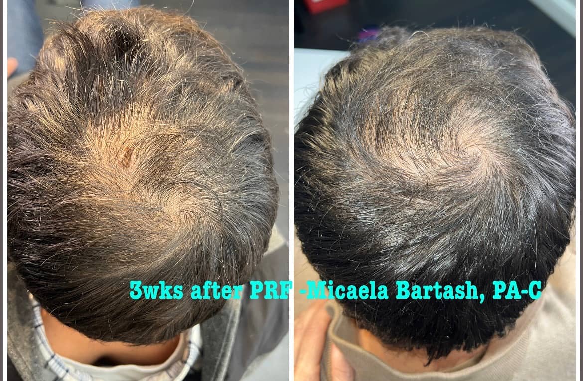 Hair Restoration