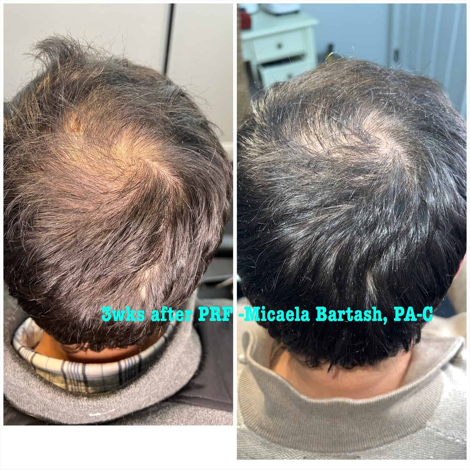 Hair Restoration