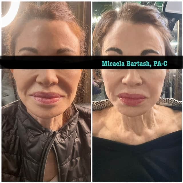 Subnovii plasma pen nasolabial folds