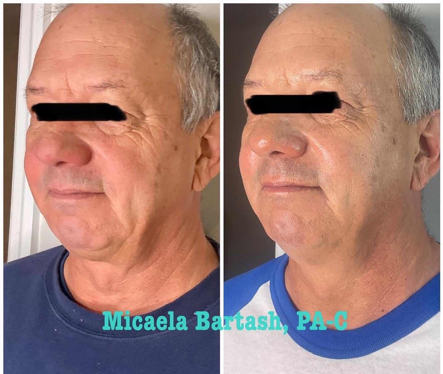 Virtue RF Microneedling