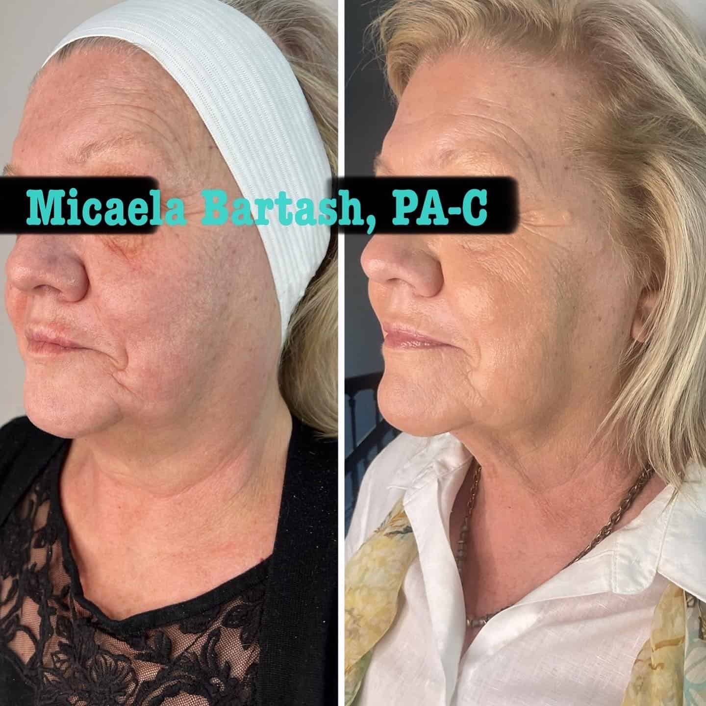 RF microneedling