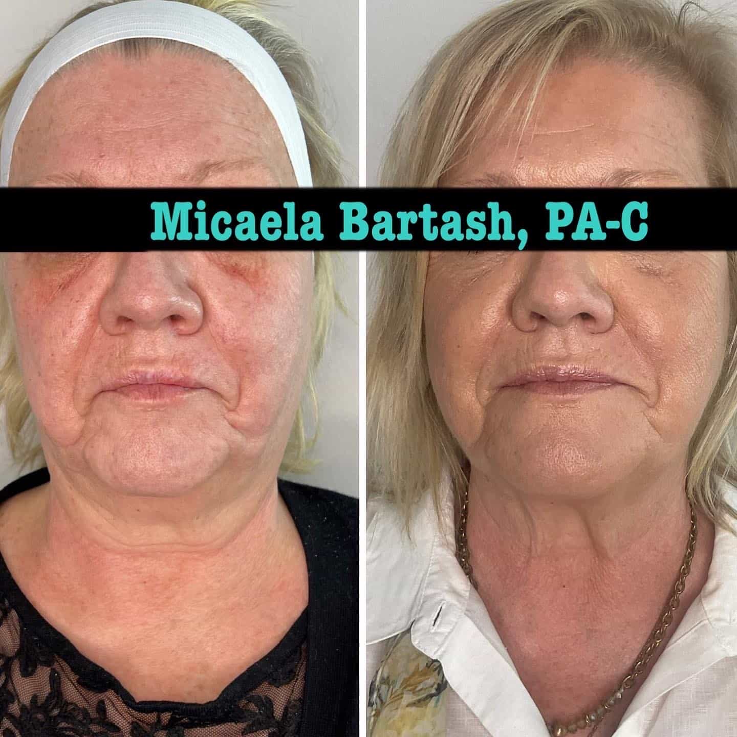 RF microneedling