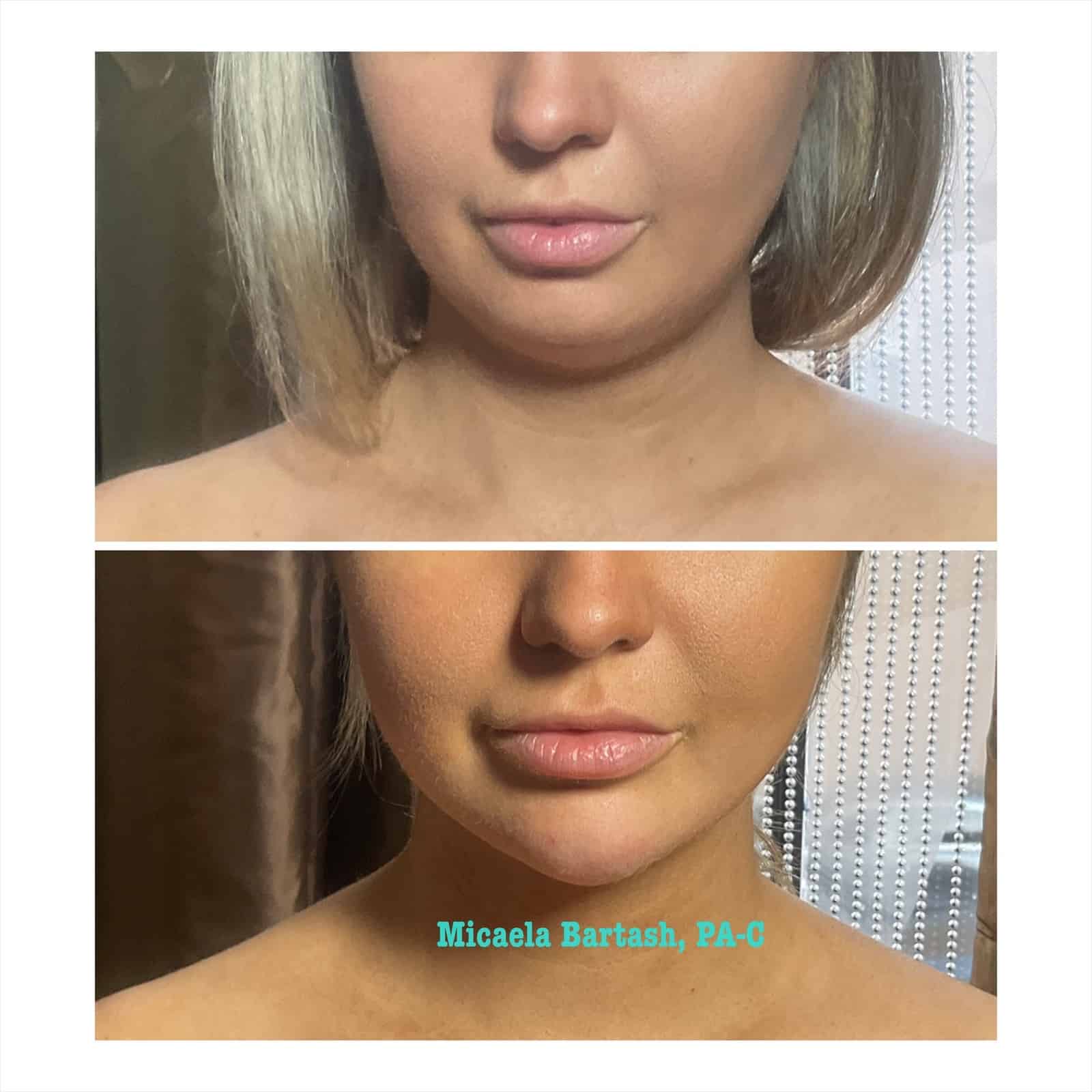 Chin Shaping with Filler