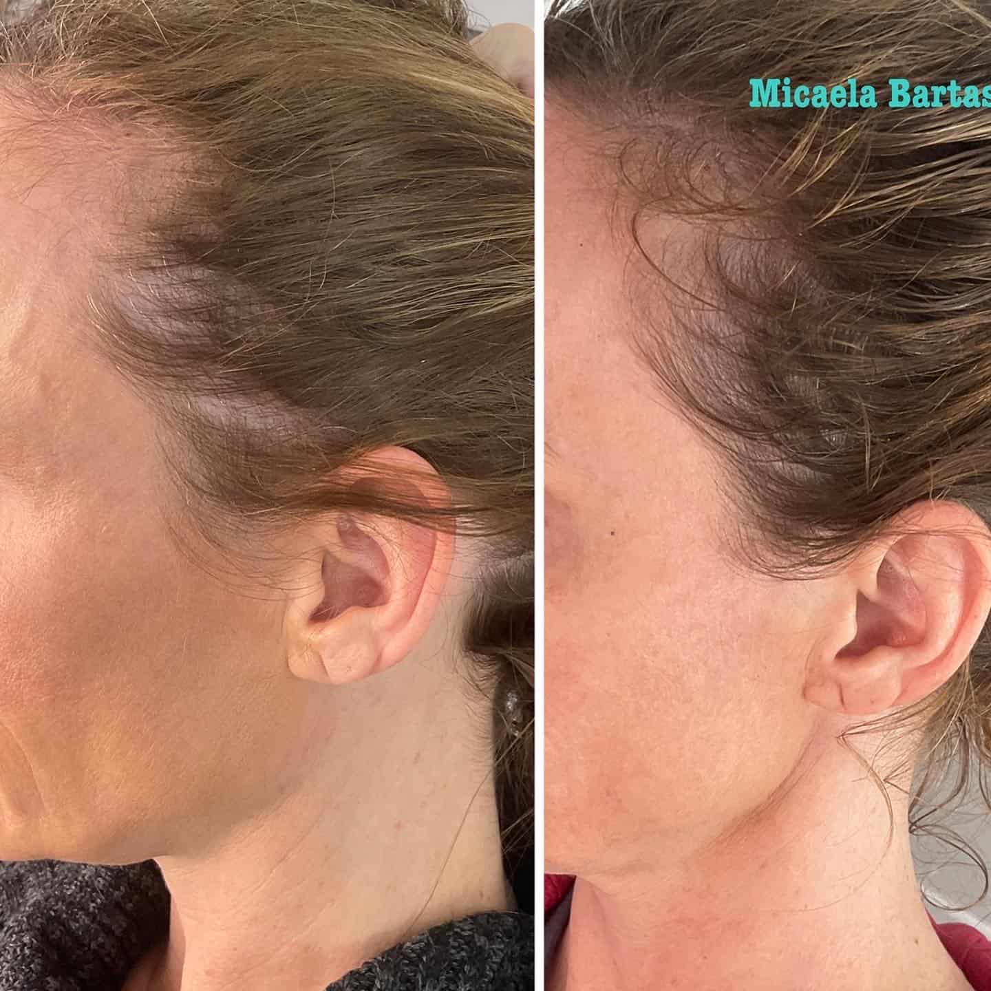 Hair Restoration