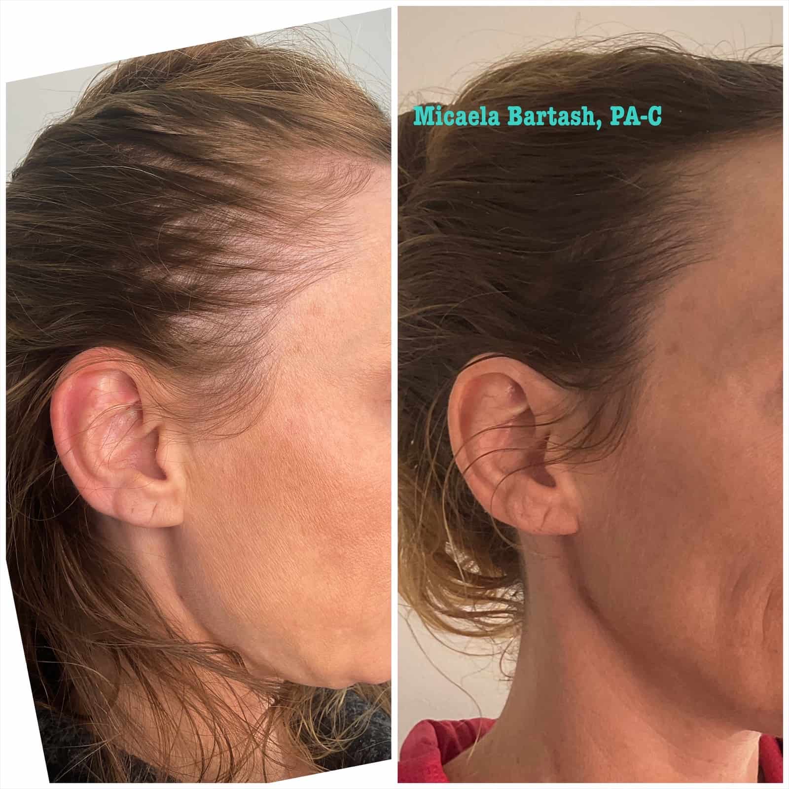 Hair Restoration