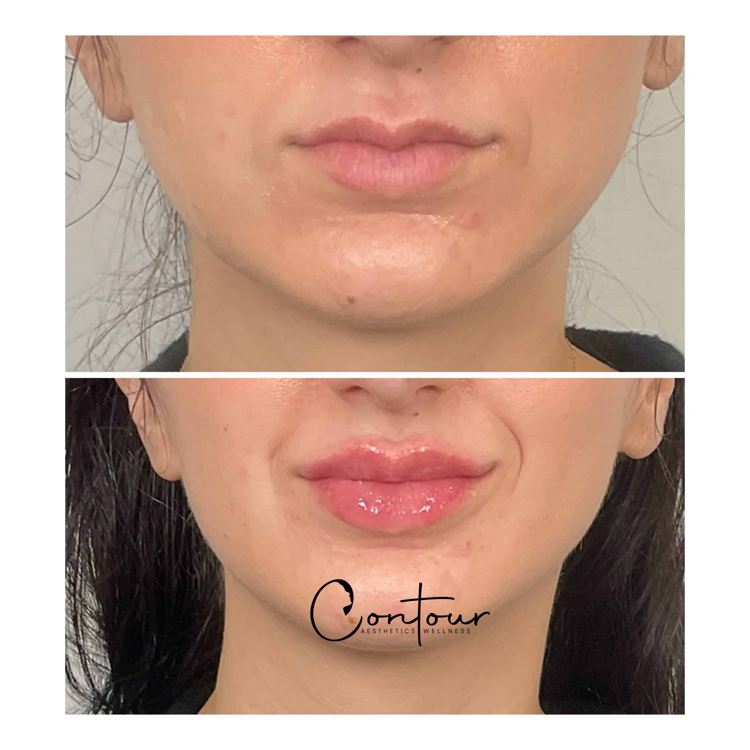 Lip Filler