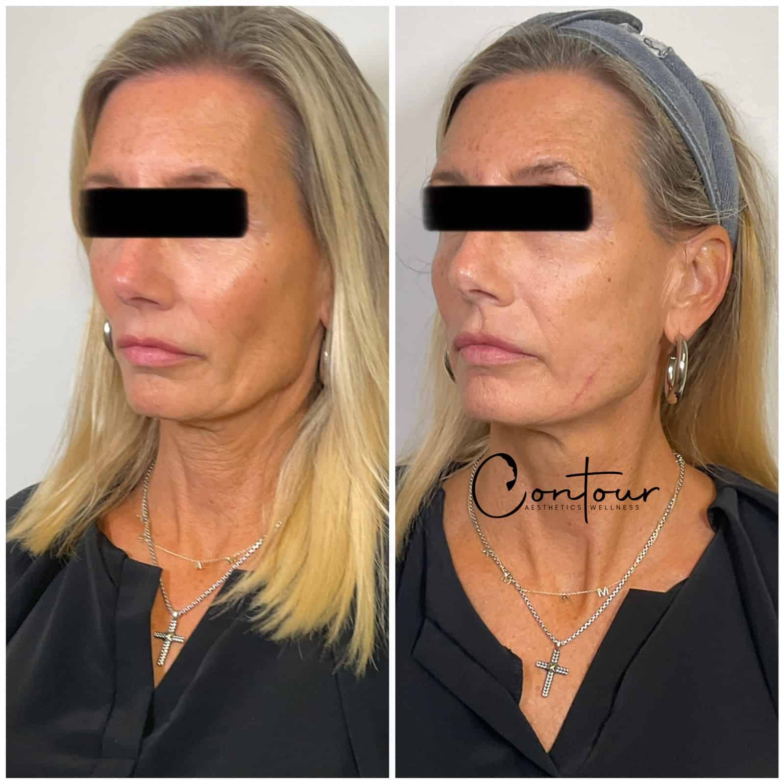 Dermal Filler before and after